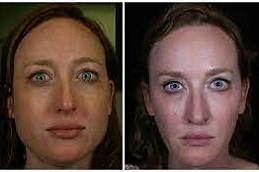 Teeth-Grinding-Treatment-in-Abu-Dhabi