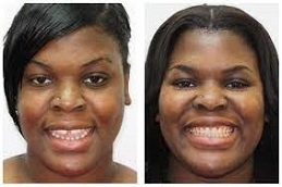 Teeth Straightening & Alignment 3 Teeth-Straightening-Alignment-in-Abu-Dhabi-Al-Ain