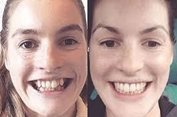 Teeth Straightening & Alignment 4 Teeth-Straightening-Alignment-in-Abu-Dhabi