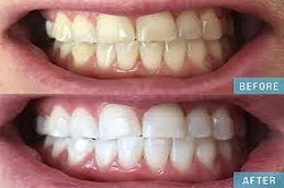 Teeth Whitening Abu Dhabi 3 Teeth-Whitening-Abu-Dhabi