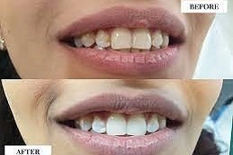 Teeth Whitening Abu Dhabi 4 Teeth-Whitening-in-Abu-Dhabi-Al-Ain