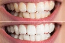 Teeth Whitening Abu Dhabi 5 Teeth-Whitening-in-Abu-Dhabi