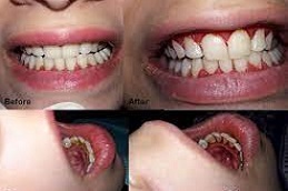 Teeth-polishing-Scaling-Treatment