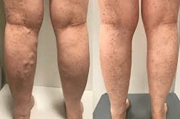 Varicose Veins Treatment in Dubai and Abu Dhabi