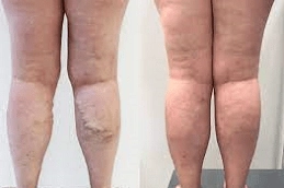 Varicose Veins Treatment