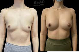 bREAST rECONSTRUCTION IN aBU dHABI & aL aIN