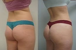 best Non surgical bum lift