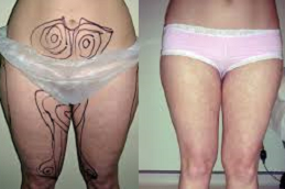 Body Jet Liposuction 3 body jet liposuction inAbu Dhabi & Al Ain