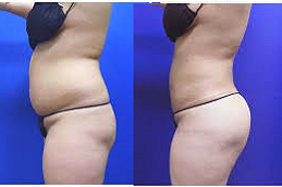 Body Jet Liposuction 4 body jet liposuction inAbu Dhabi