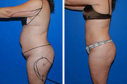 Body Jet Liposuction 5 body jet liposuction