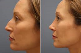septoplasty Clinic in UAE
