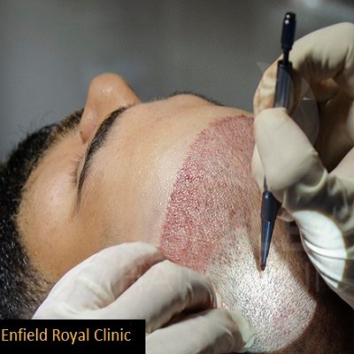 زراعة الشعر بتقنية FUE " بالاقتطاف" 1 FUE Hair Transplant in Abu Dhabi