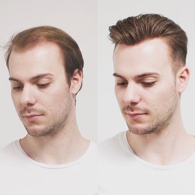 عملية استبدال الشعر 1 Hair Replacement in Abu Dhabi
