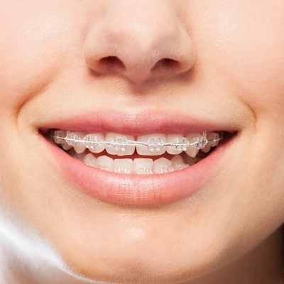 Metal Braces in Abu Dhabi