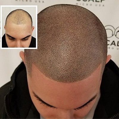 Scalp Micropigmentation in Abu Dhabi