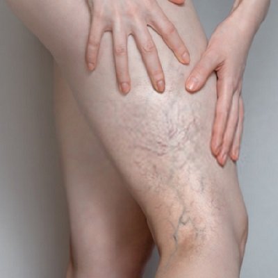 علاج الدوالي 1 علاج الدوالي في أبو ظبي