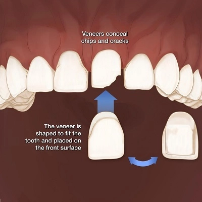 فينير الاسنان في ابوظبي