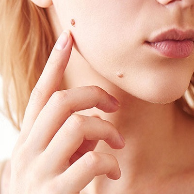 إزالة الآفات الجلدية 1 إزالة الآفات الجلدية في أبو ظبي