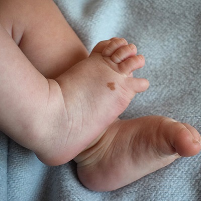 علاج الورم الوعائي (الوحمة) 1 علاج الورم الوعائي في أبوظبي