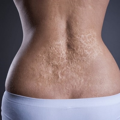 جراحة ترميم الحروق في أبو ظبي 1 جراحة ترميم الحروق في أبو ظبي