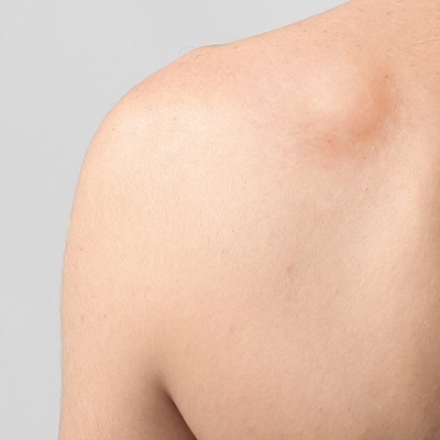 علاج الورم الشحمي في أبو ظبي