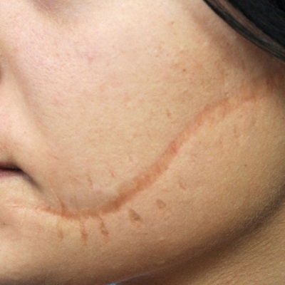 علاج ندبات الوجه في أبو ظبي 1 مراجعة ندبة الوجه في أبو ظبي