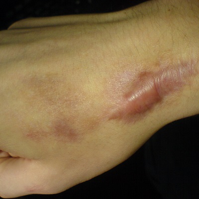 إزالة الندبات المتضخمة في أبو ظبي