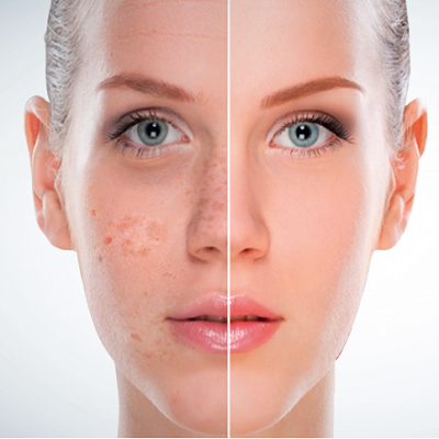 علاج تصبغ الجلد 1 تصبغ الجلد في أبو ظبي