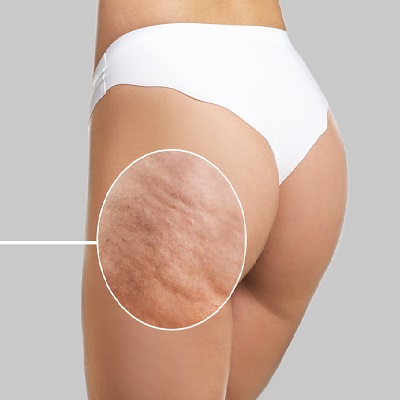 علاج إزالة السيلوليت 1 علاج إزالة السيلوليت في أبو ظبي