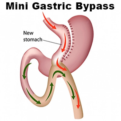 عملية تحويل مسار المعدة المصغرة 1 عملية تحويل مسار المعدة المصغرة في أبو ظبي