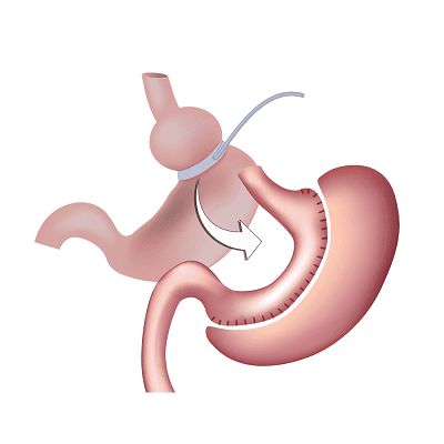 جراحة تصحيح السمنة 1 جراحة تصحيح السمنة في أبو ظبي
