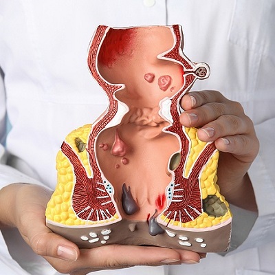 علاج البواسير 1 علاج البواسير في أبوظبي