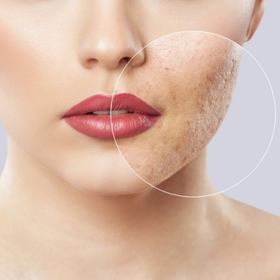 علاج ندبات حب الشباب 1 علاج ندبات حب الشباب في أبو ظبي