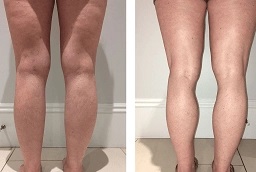 جي بلازما للفخذين والذراعين في أبوظبي قبل بعد