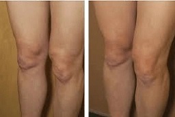 جي بلازما للفخذين والذراعين في أبوظبي قبل وبعد