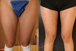 قبل وبعد جي بلازما للفخذين والذراعين في أبوظبي