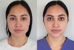 شد الوجه في أبو ظبي قبل بعد