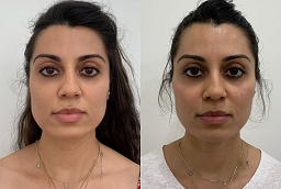 شد الوجه في أبو ظبي قبل وبعد