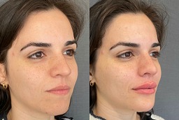 علاج تنعيم التجاعيد في أبو ظبي قبل بعد