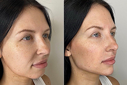 علاج كيبيلا 8 علاج كيبيلا في أبو ظبي قبل بعد