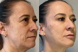 قبل وبعد علاج تنعيم التجاعيد في أبو ظبي