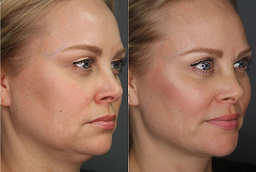 قبل وبعد علاج كيبيلا في أبو ظبي