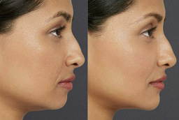 تصغير الذقن 7 تصغير الذقن في أبو ظبي قبل وبعد