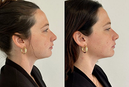 حقن الدهون 8 حقن الدهون في أبو ظبي قبل بعد