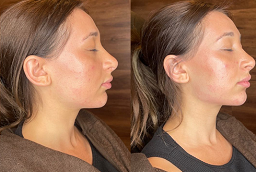 حقن الدهون في أبو ظبي قبل وبعد