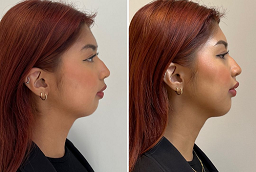 قبل وبعد حقن الدهون في أبو ظبي