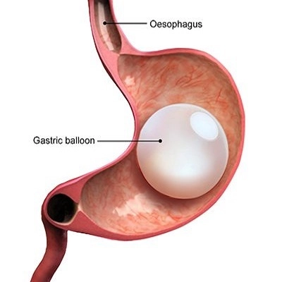 Gastric Balloon Placement in Abu Dhabi | Weight Loss