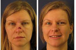 Facial Scar Revision 5