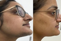 before & After laser hair removal in Abu Dhabi