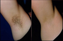 laser hair removal before & after